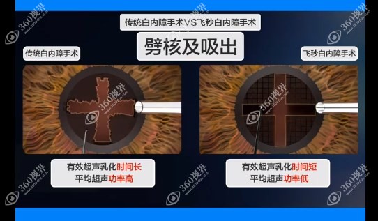 白内障飞秒激光手术与超声乳化