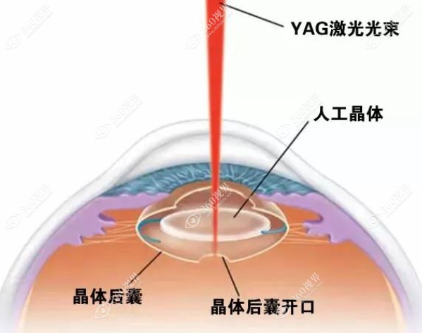 YAG激光治疗