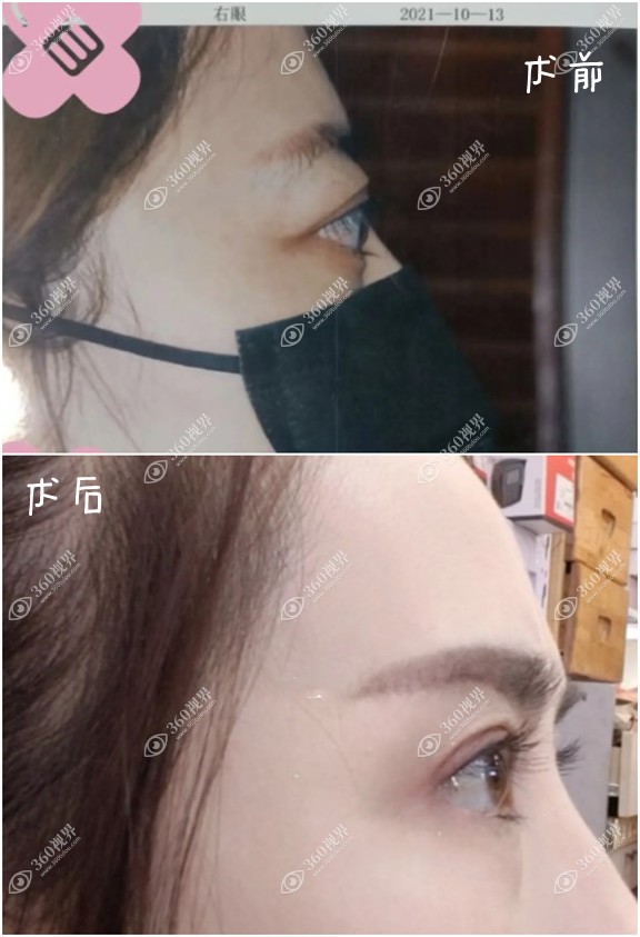 甲亢突眼~眶减压术后14个月后对比照