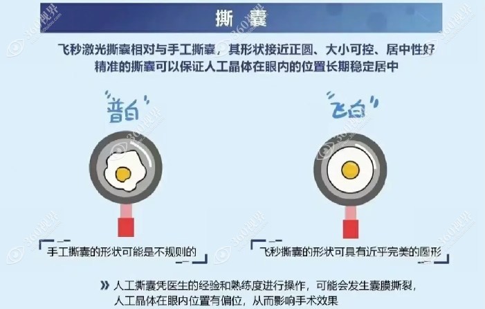 白内障飞秒激光手术与超声乳化撕囊