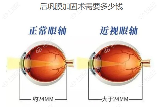 后巩膜加固术需要多少钱