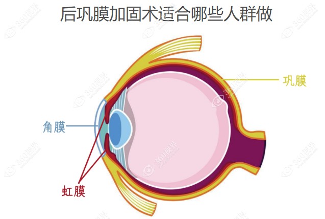 后巩膜加固术适合哪些人群做