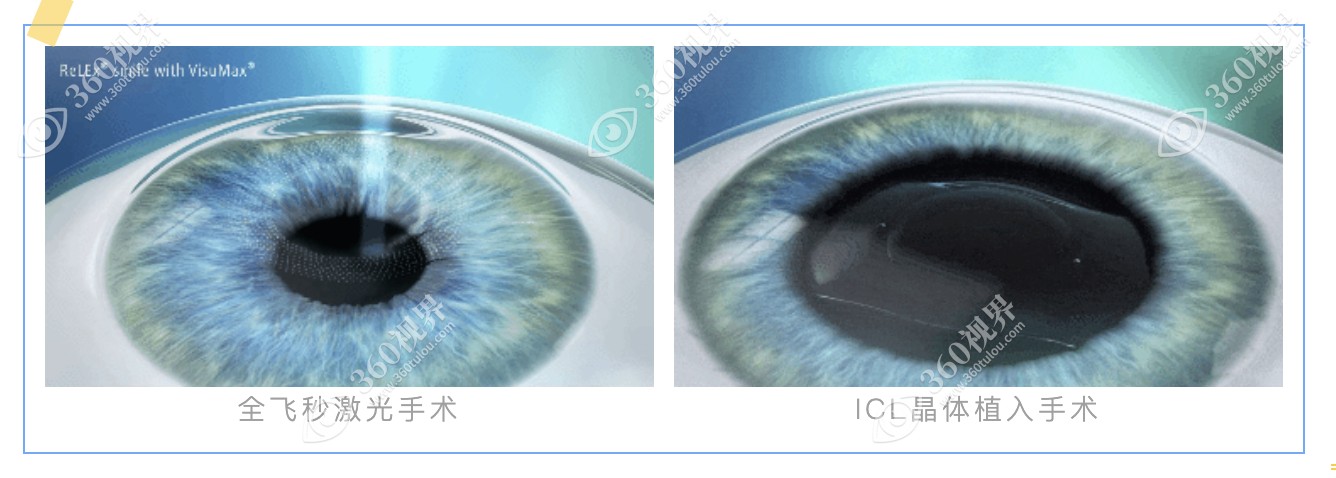 昆明康特森眼科医院做近视眼手术价格收费不高-360视界