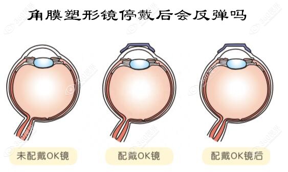 角膜塑形镜停戴后会反弹吗?不会,OK镜是控制近视度数增长的