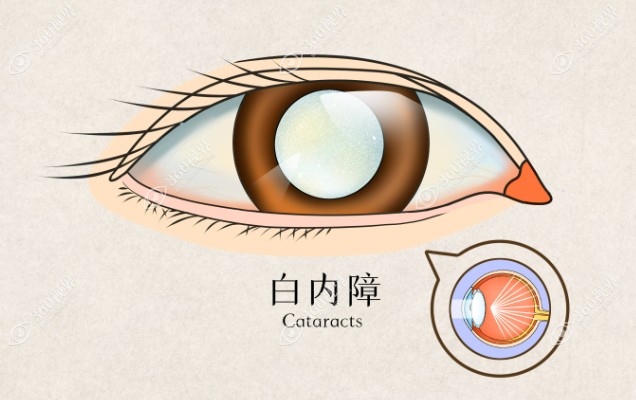 宁波晶体植入价格查询