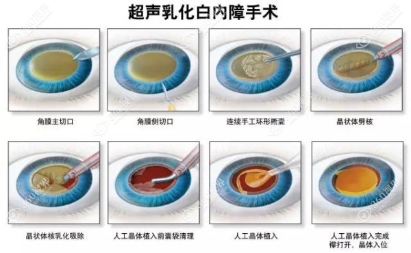 西安市中心医院眼科杜兆江医生技术优势
