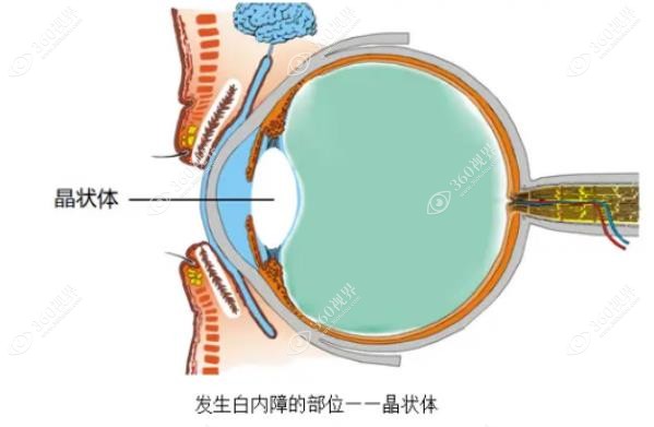 白内障手术后多久能恢复正常视力
