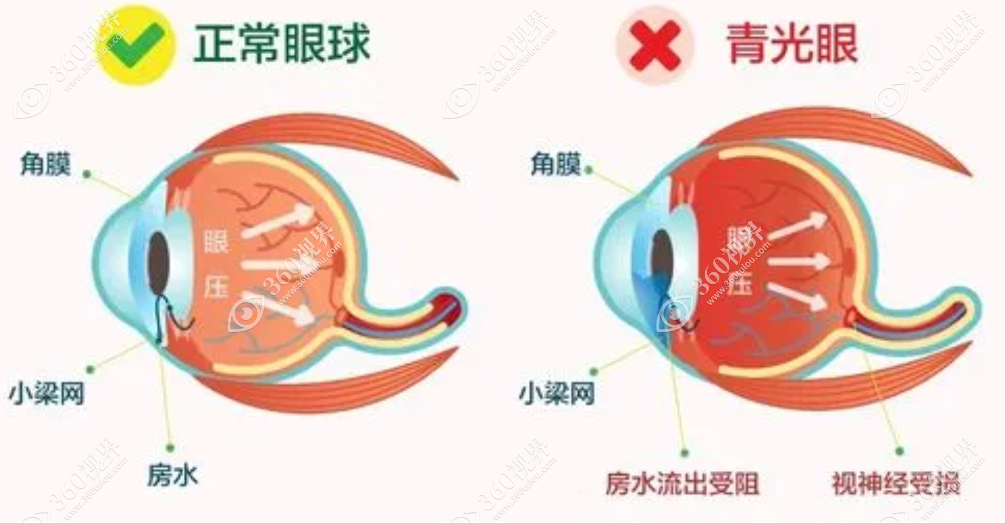 青光眼与正常眼对比