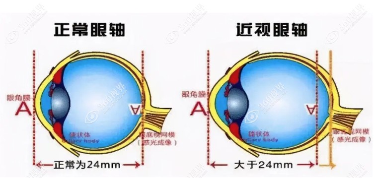 近视眼突