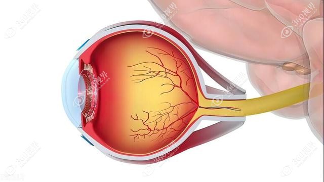 玻璃体混浊可以做近视眼手术且与角膜并无明显的关联
