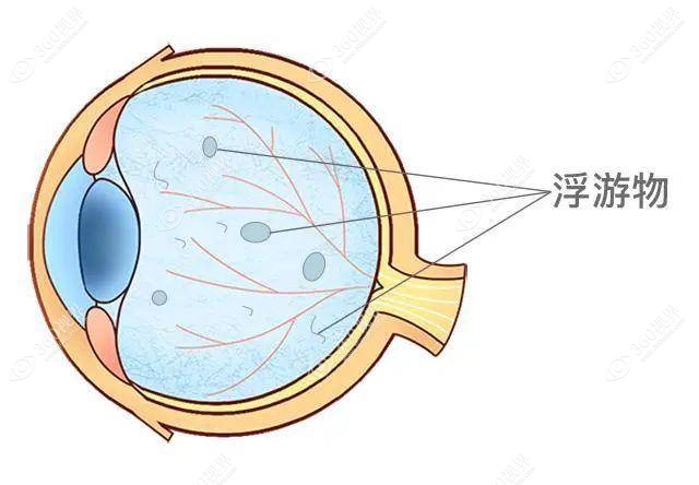 玻璃体混浊可以做近视眼手术，但不能缓解原本存在的玻璃体混浊
