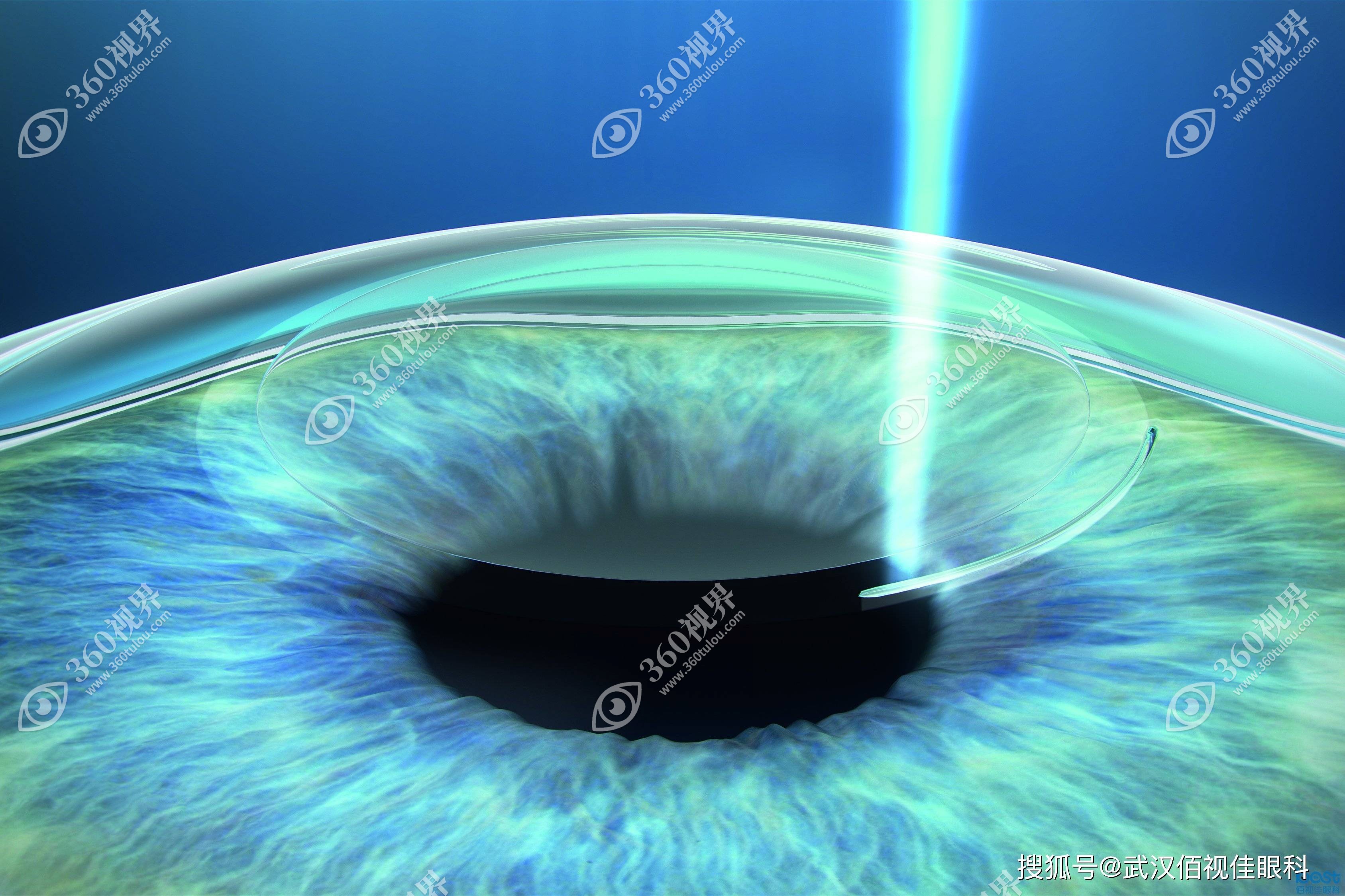 玻璃体混浊可以做近视眼手术，但若玻璃体混浊程度重则需先治疗再手术