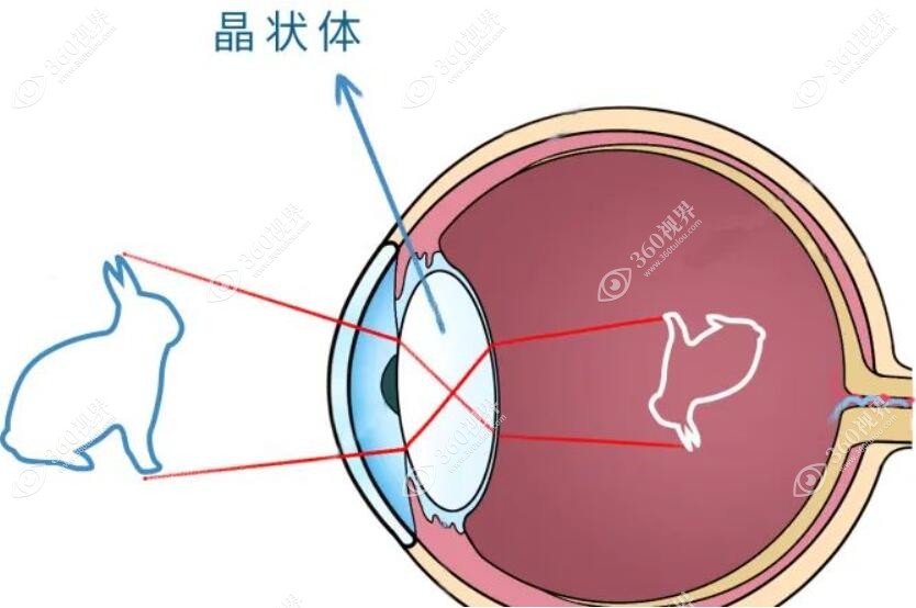 晶体植入修复白内障360tulou.com