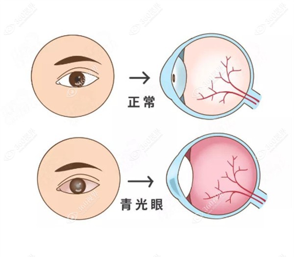 青光眼的症状和表现是什么?解答青光眼的早期症状6个表现
