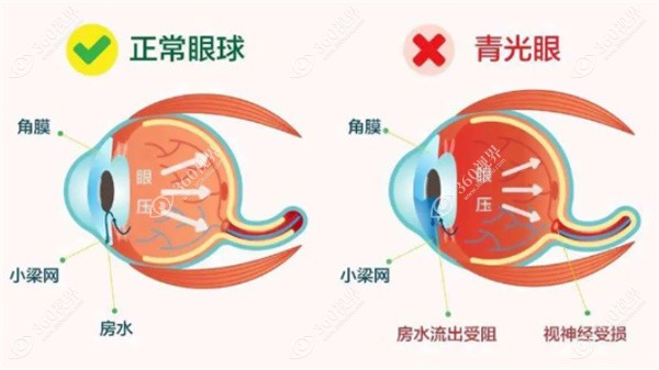 什么是青光眼