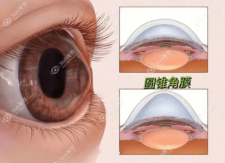 激光辅助角膜移植手术的优势