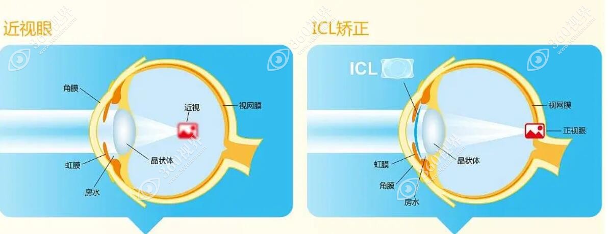 晶体置换手术治疗