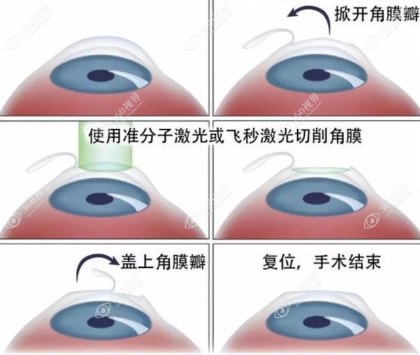 激光近视手术步骤示意图
