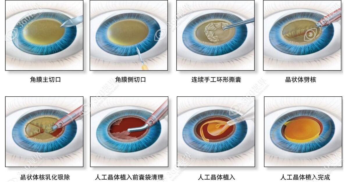 晶体植入手术过程