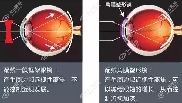 济南麦迪格眼科角膜塑形镜多少钱