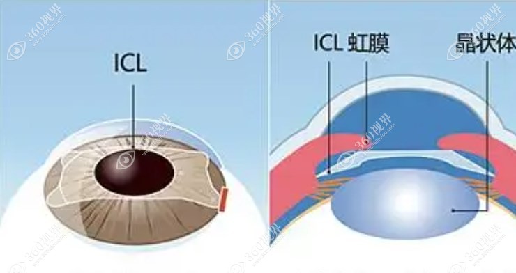 icl晶体植入手术能报销吗?一般不能,双眼总费用3w左右
