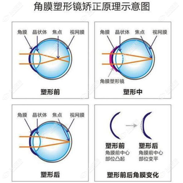 麦迪格眼科角膜塑形镜多少钱360tulou.com