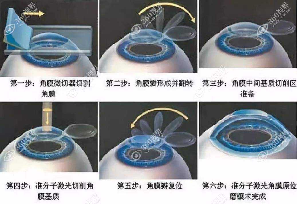 郑州近视眼矫正手术价格一览表