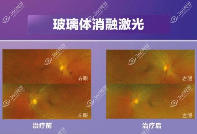 激光消融术治疗飞蚊症前后对比