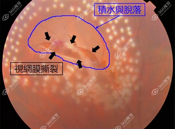 激光消融术治疗飞蚊症的原理