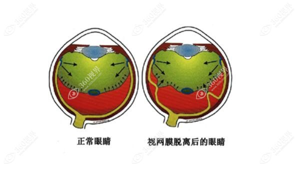 视网膜脱落前后症状