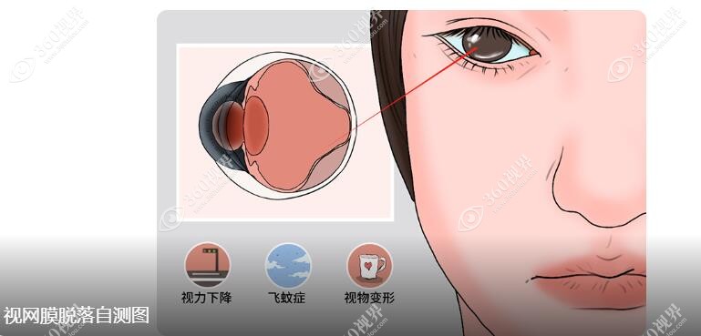 视网膜脱落自测图360tulou.com