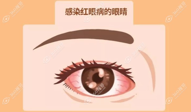 感染红眼病的眼睛www.360tulou.com