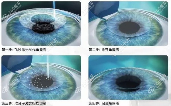温州瑞安人民医院眼科飞秒激光手术好