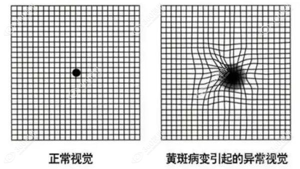 视网膜黄斑病变的原因360tulou.com