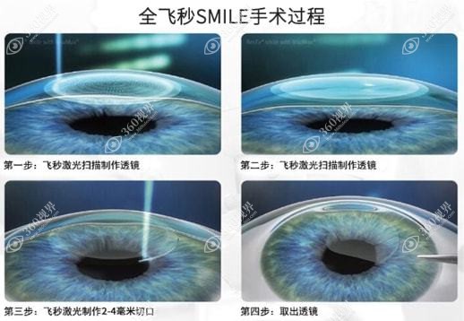SMILE近视眼手术是全飞秒.360tulou.com