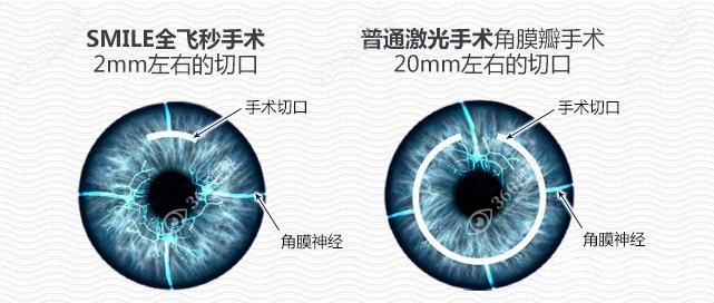 全飞秒smile近视眼手术优缺点