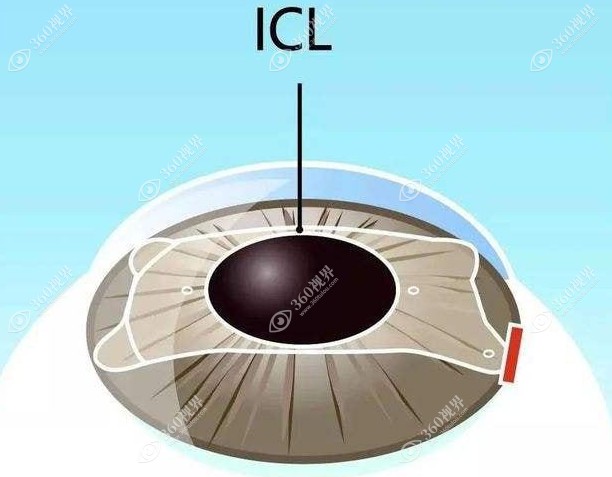 ICL人工晶体植入手术360视界