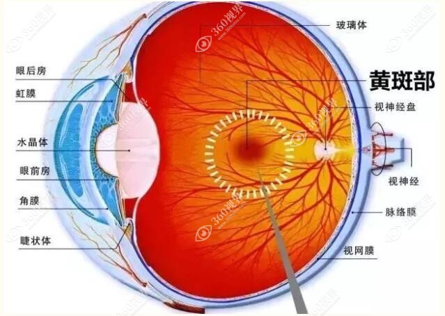 视网膜黄斑病变是什么原因引起的?遗传/高度近视/年龄增长