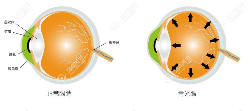 青光眼治疗方法有几种？