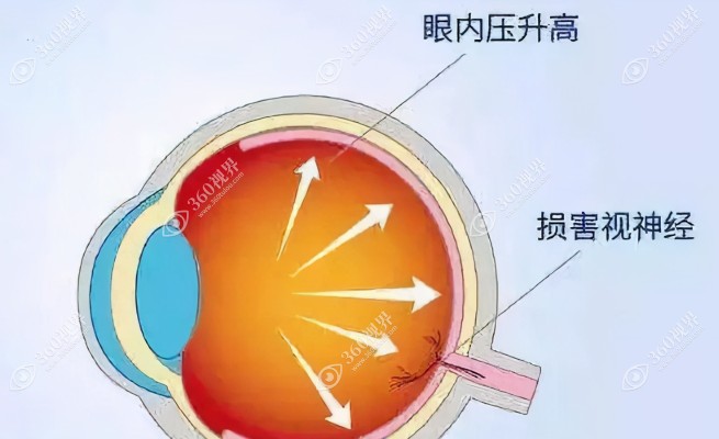 青光眼手术后注意事项