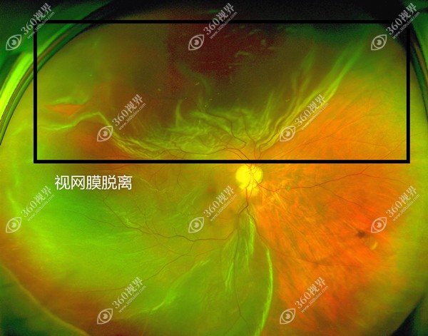 视网膜脱离手术www.360tulou.com