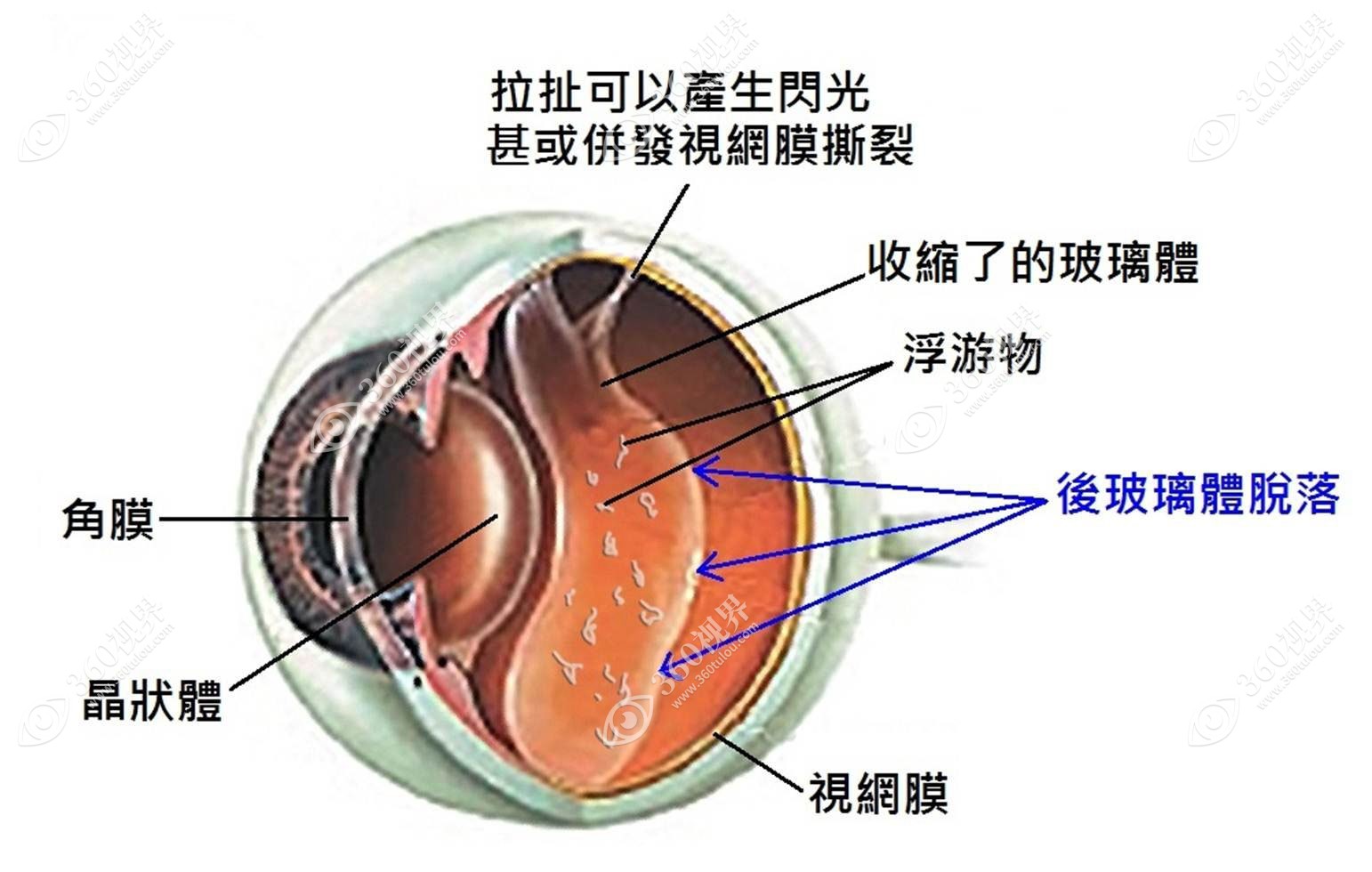 视网膜脱离手术后会再次脱离吗