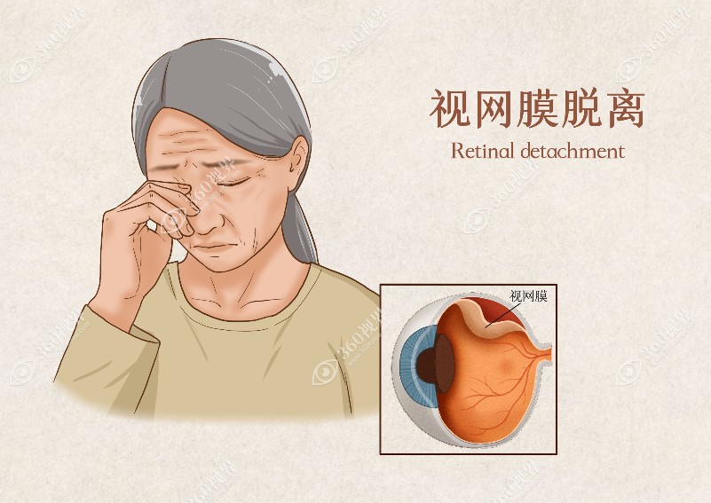 视网膜二次脱落的几率