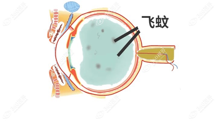 分蚊症是白内障的早期症状吗