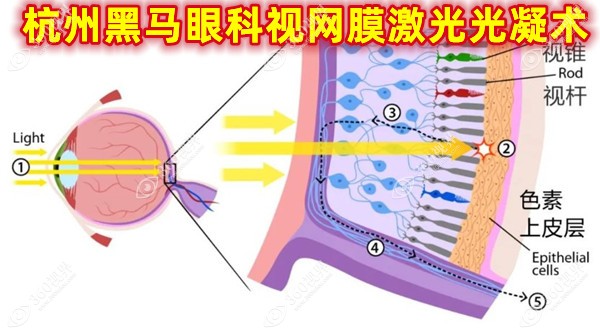 杭州黑马眼科视网膜激光光凝术—20分钟解决视网膜裂孔