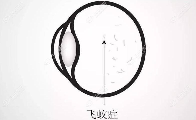 如何判断飞蚊症是生理性还是病理