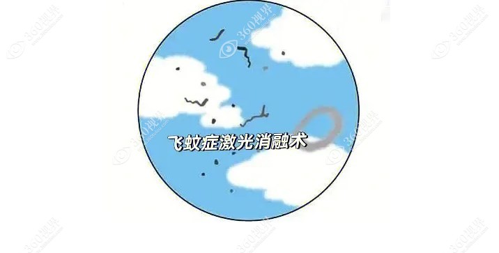 飞蚊症激光消融术