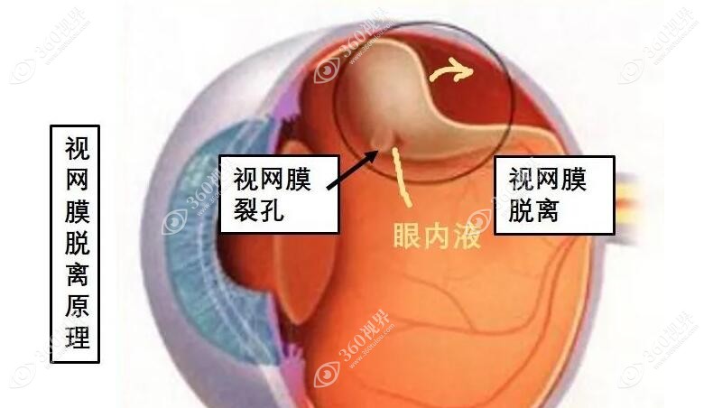 高度近视导致视网膜穿孔不能做近视手术