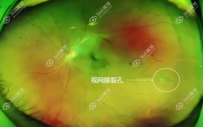 视网膜裂孔能做近视眼手术吗？高度近视视网膜穿孔不能做..