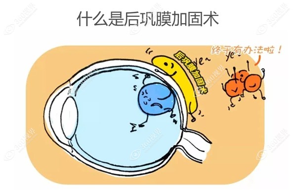 什么是后巩膜加固术